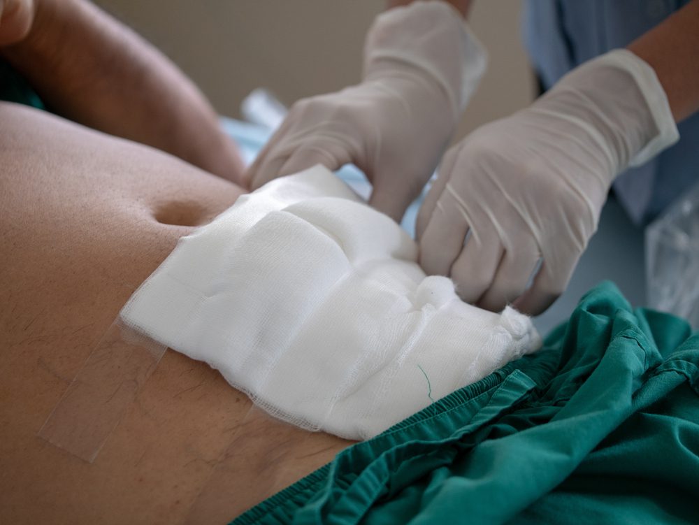 Cirurgia de hérnia: o que é e seus benefícios