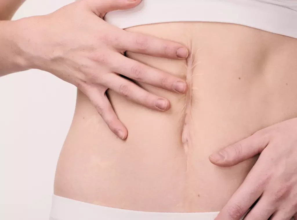 hérnia abdominal