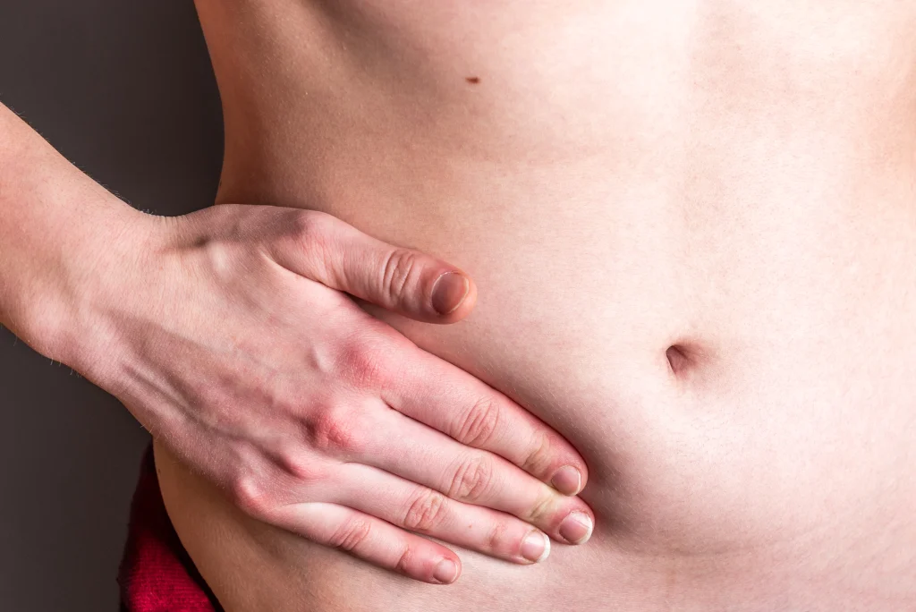  hérnia abdominal